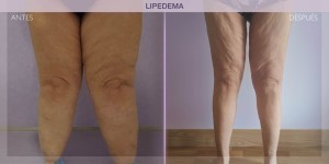 Before and after pictures of Lipedema treatment